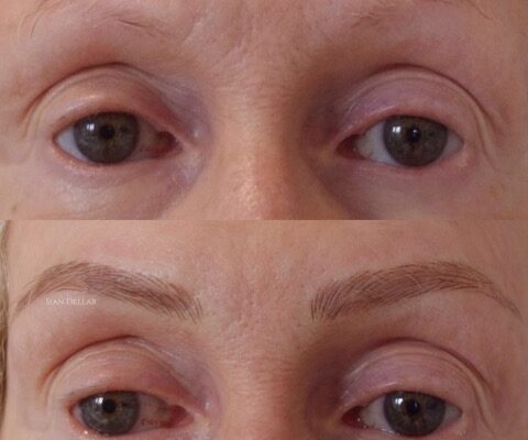 Microblading for hair loss and other medical conditions