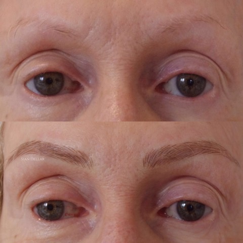 Microblading for hair loss and other medical conditions