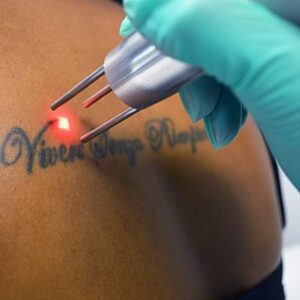 tattoo removal