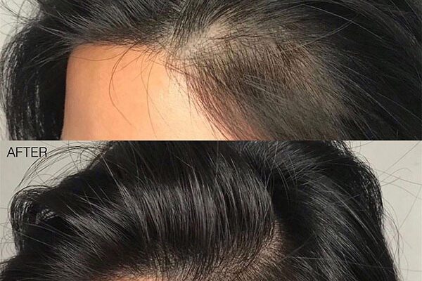 female scalp micropigmentation by sian dellar clinic