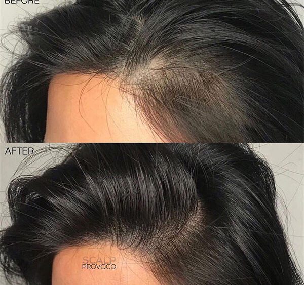 female scalp micropigmentation by sian dellar clinic