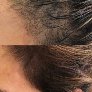 scalp micropigmentation