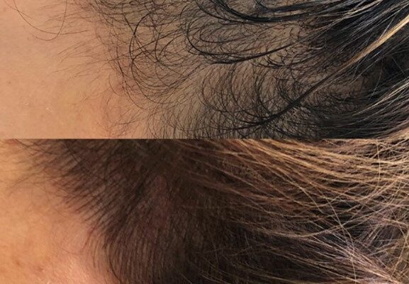 scalp micropigmentation