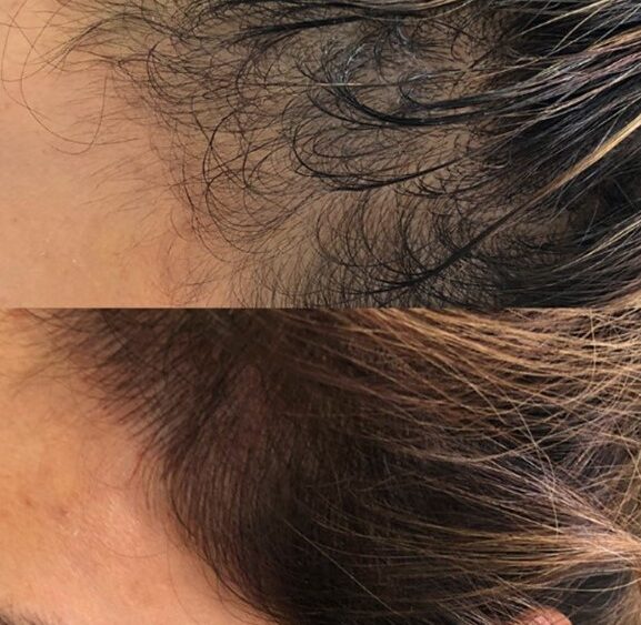 scalp micropigmentation