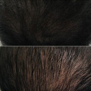 hair thinning treatment
