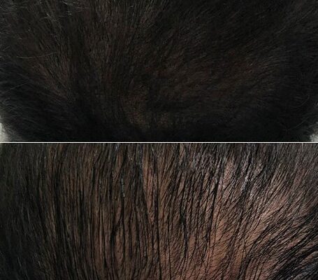 hair thinning treatment