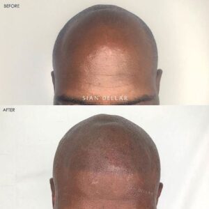 scalp micropigmentation harley street