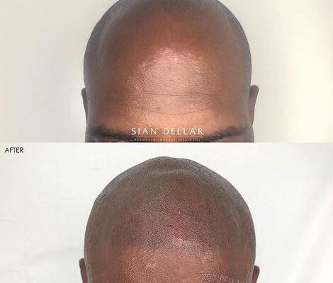 scalp micropigmentation harley street