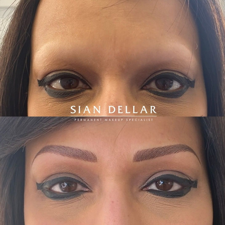 Medical microblading for total hairloss