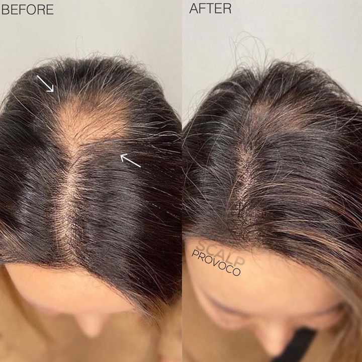 female scalp micropigmentation