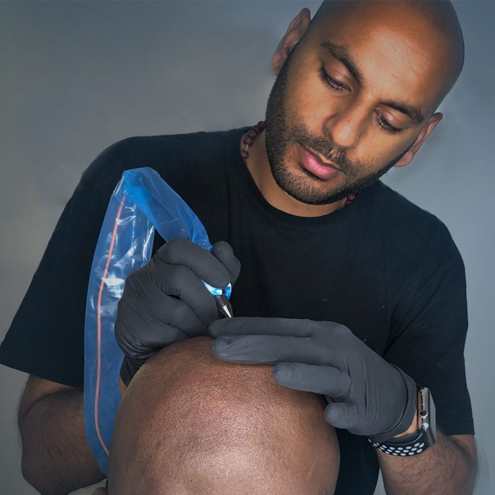 ravi-scalp-micropigmentation-men ravi scalp micropigmentation men