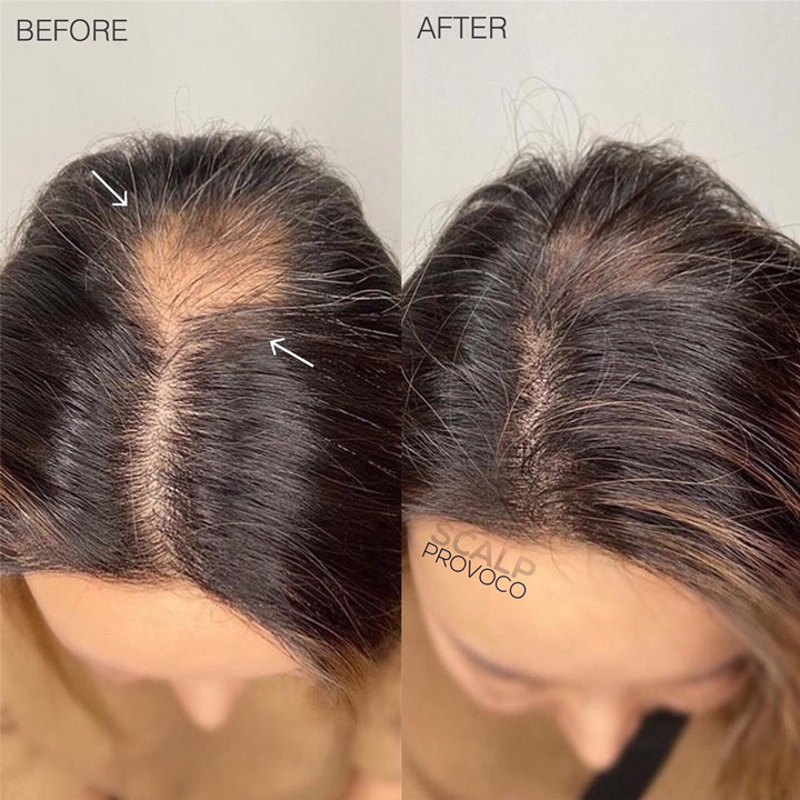 scalp micropigmentation female hairloss