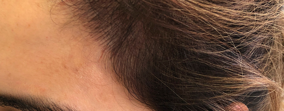 women hair scalp micro pigmentation after
