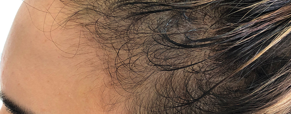 women hair scalp micro pigmentation before