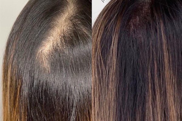 Womens scalp micropigmentation