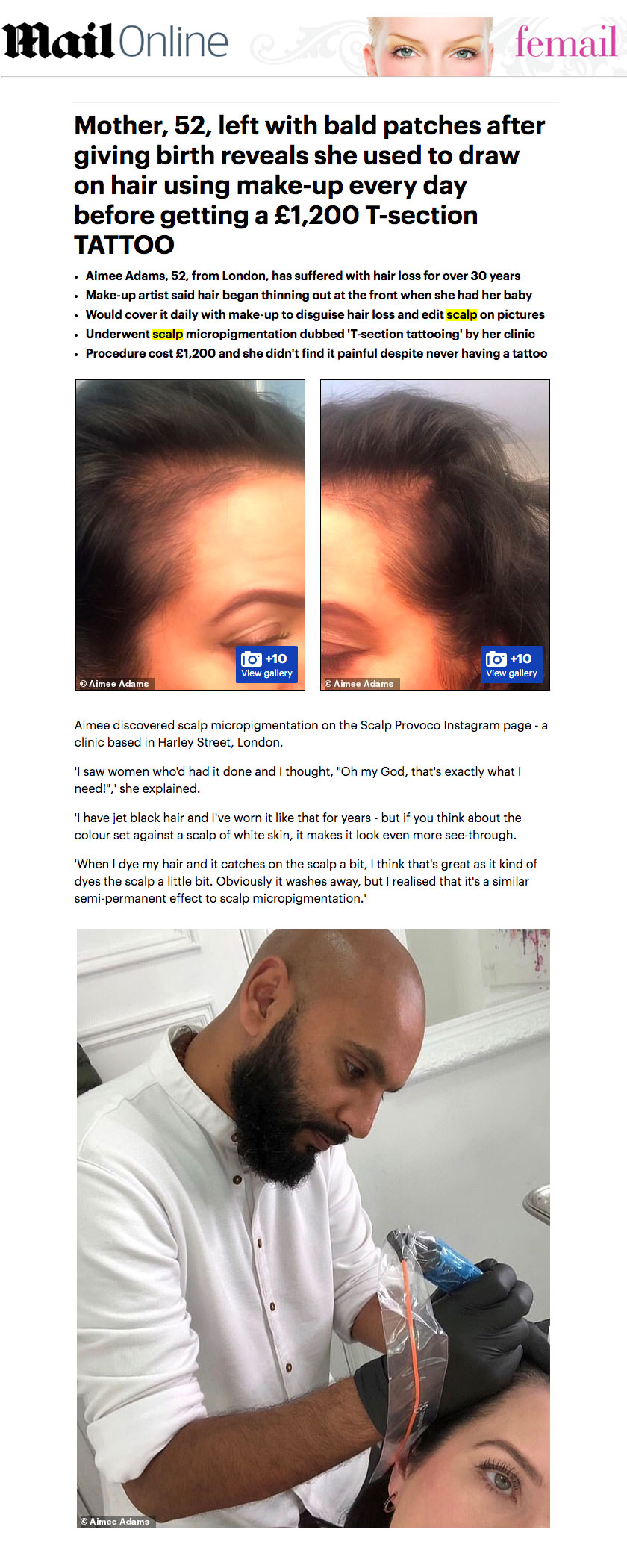 mail online preview scalp micro pigmentation