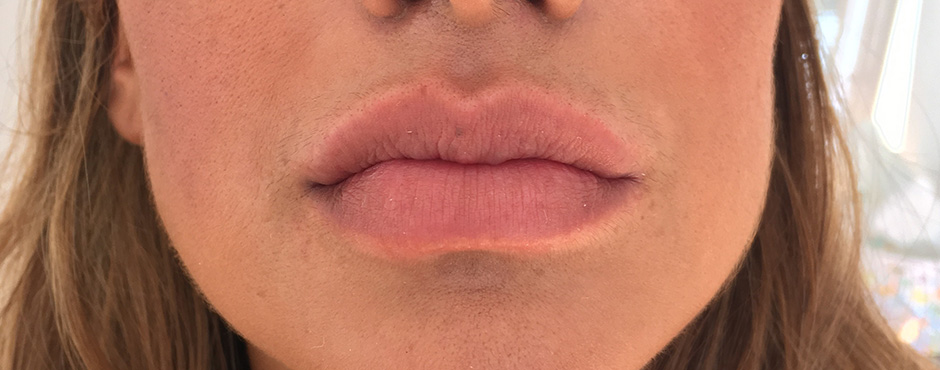 lip blush 4 before
