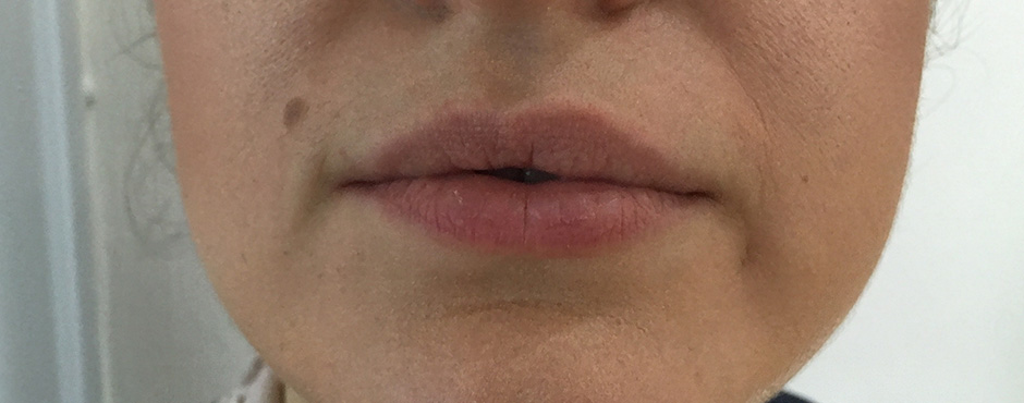 lip blush 5 before