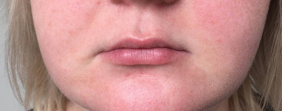lip blush 6 before