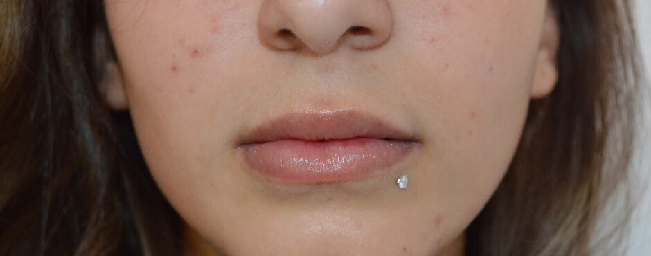 lip blush 9 before