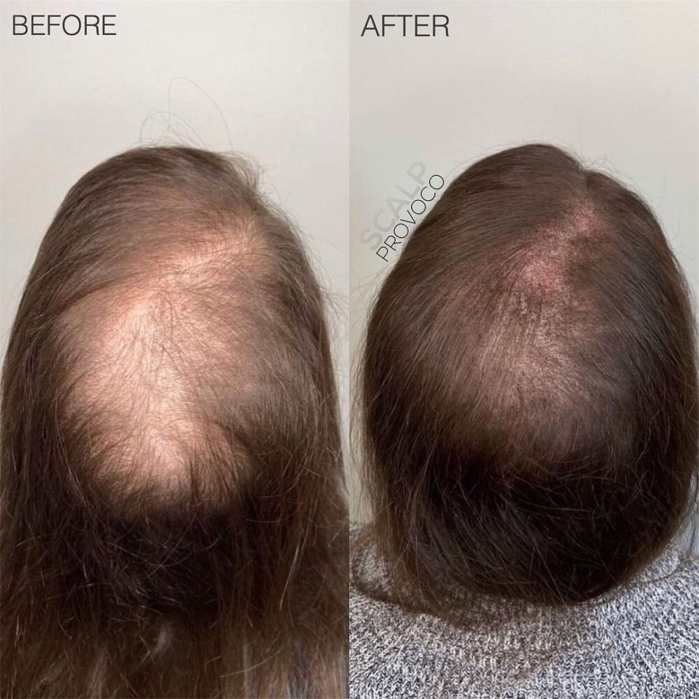 SMP for female pattern hair loss