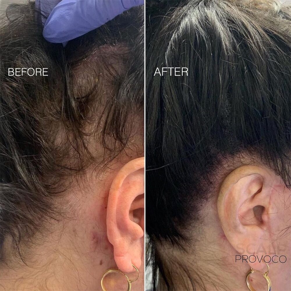SMP for alopecia or balding in females