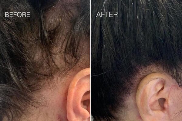 SMP for alopecia or balding in females