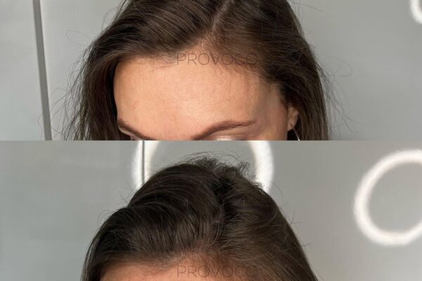 Scalp micropigmentation for fuller looking hair