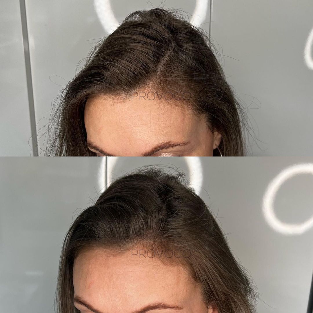 before and after scalp micropigmentation