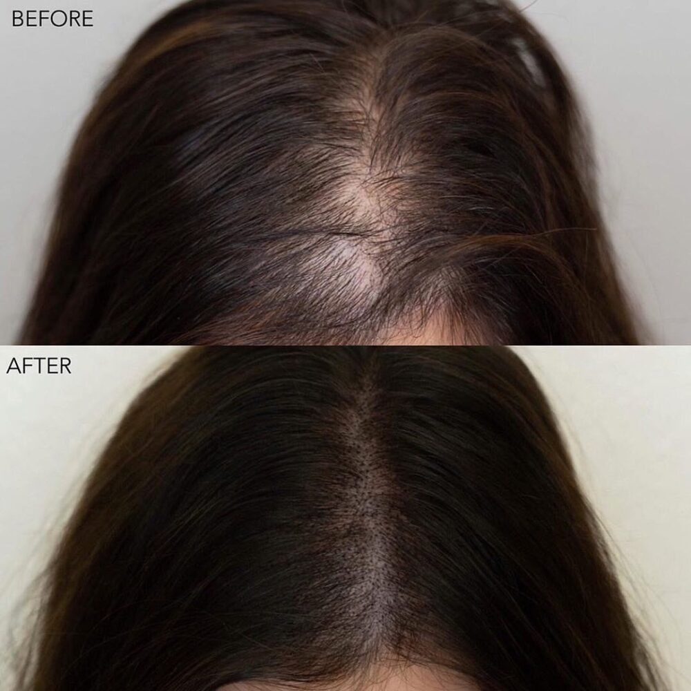 Getting scalp micropigmentation for female frontal hair loss