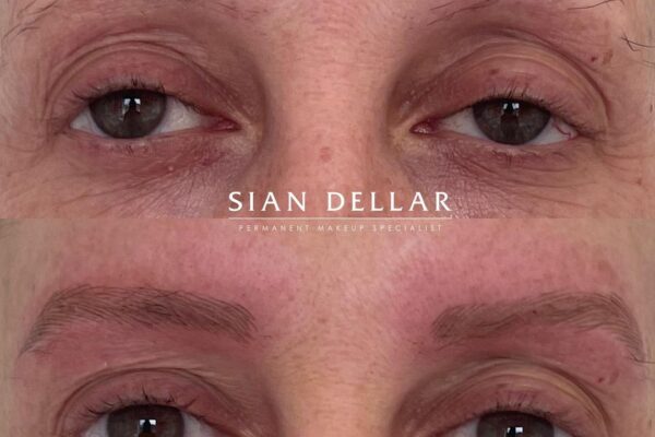 Client microblading for almost complete eyebrow loss