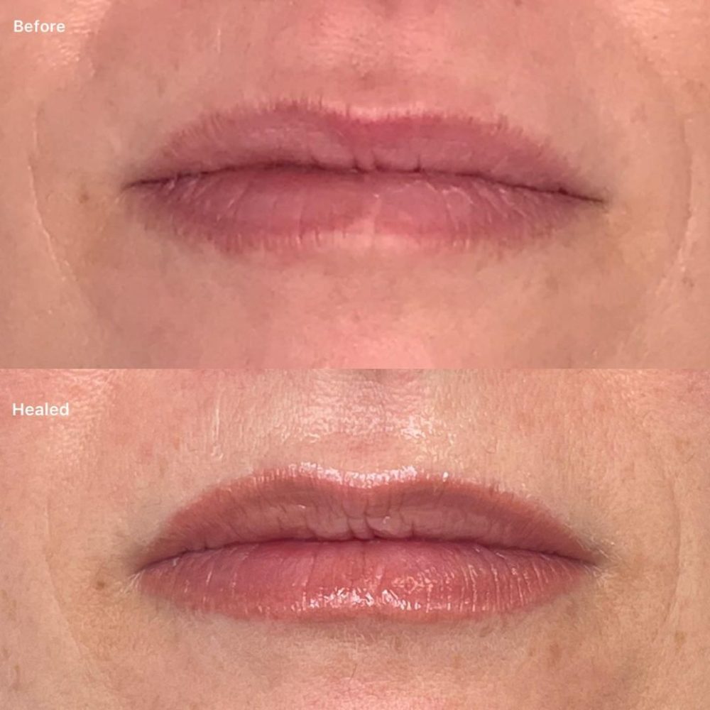 Subtle lip enhancement for a natural look