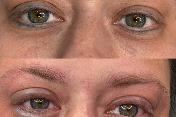 Effective permanent eyeliner removal
