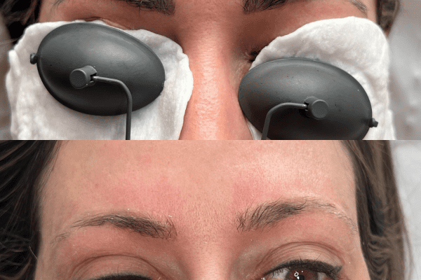 Laser Microblading Removal