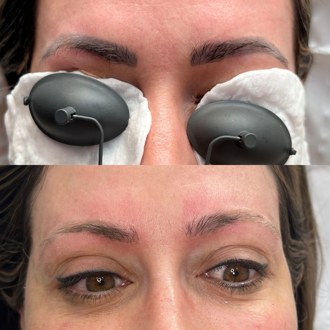 laser brows removal Before and after laser removal for microbladed brows