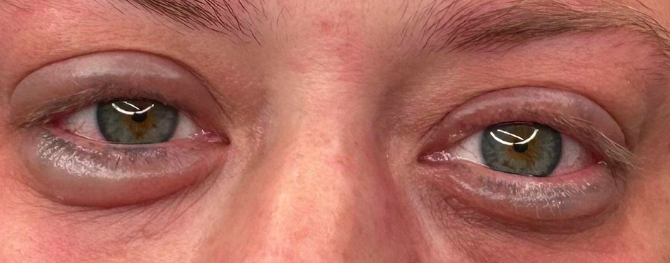 permanent eyeliner removal after