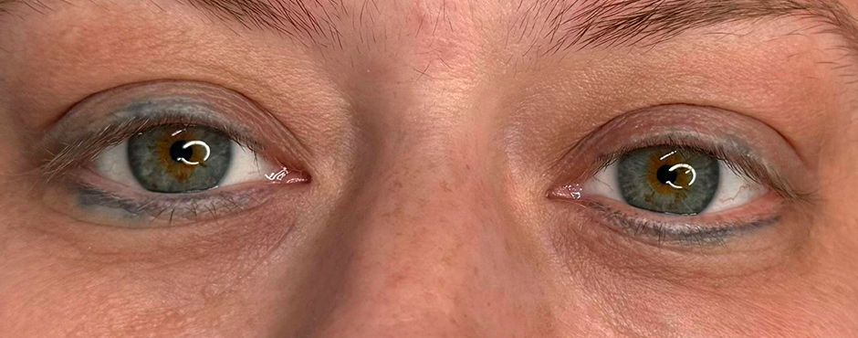 permanent eyeliner removal before