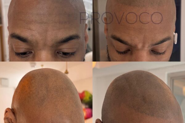 SMP for an even hairline and full shaved head look