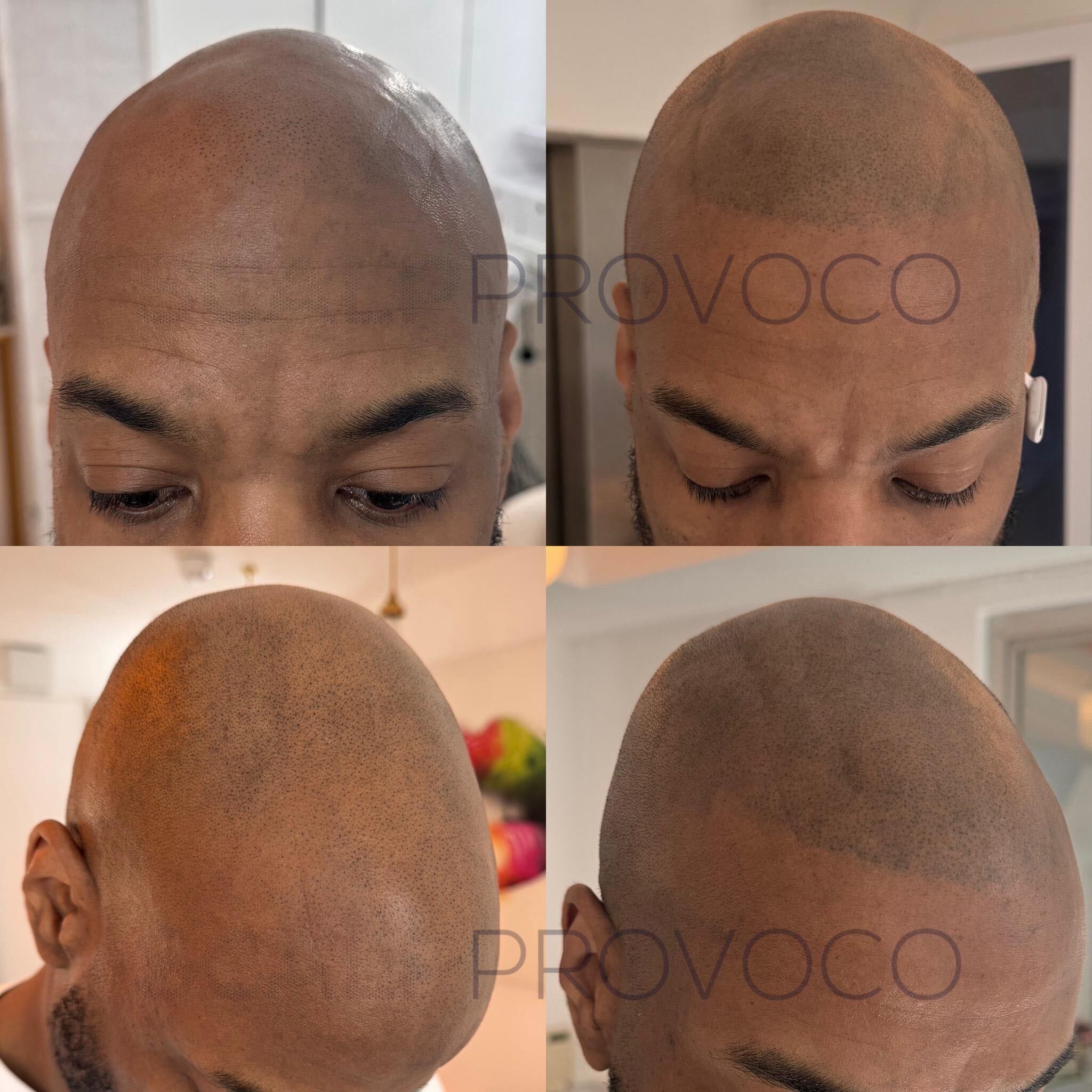 Before and after SMP results